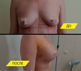 Случай значительной разницы по уровню субмаммарной складки. Фото результата сделано на следующий день после операции увеличения груди имплантами.