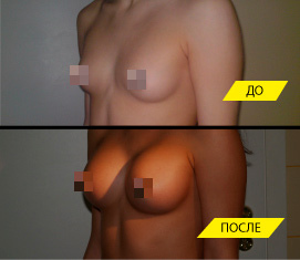 Увеличение груди анатомическими имплантами.