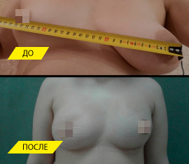 Резкая асимметрия по форме и объему молочных желез. Фото до и через 2 недели после операции. Выполнена циркулярная мастопексия с одной стороны, а с другой - эндопротезирование груди.
