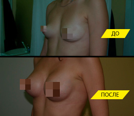 Эндопротезирование груди. Доступ ареолярный.