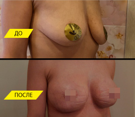Установка имплантов с циркулярной подтяжкой груди.