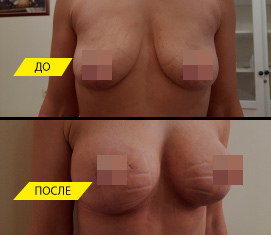 Имплантация груди с циркулярной подтяжкой.